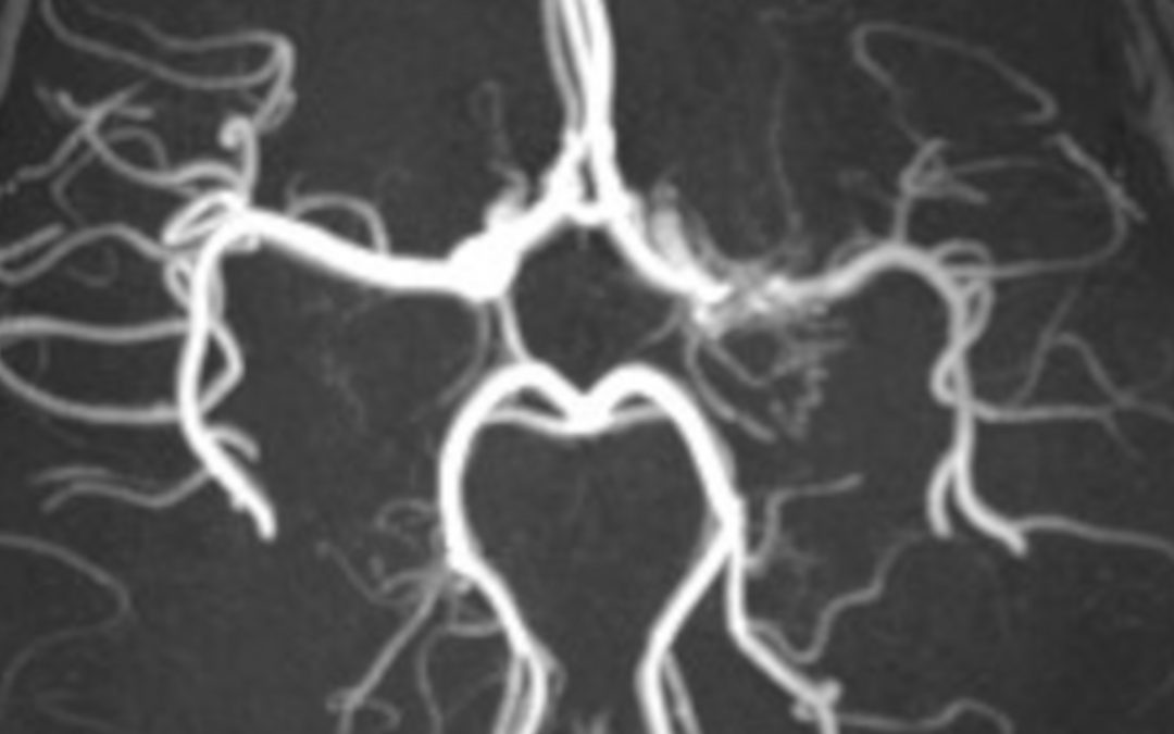 À lire dans Emerging Neurologist : maladie de Moya Moya, deux cas étudiés au CHU de Rennes