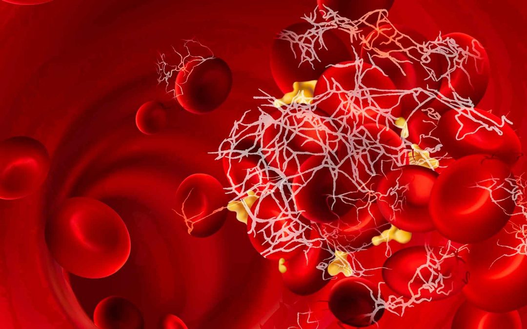 Étude RIPORT : rivaroxaban 15 mg dans la thrombose de la veine porte non cirrhotique