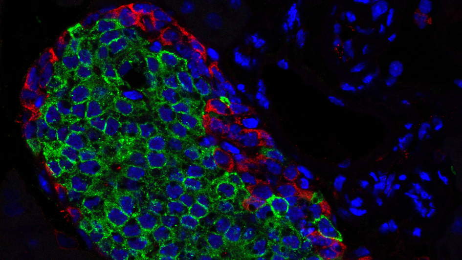 Syndrome de surcroissance : des mutations du gène PIK3CA identifiées dans les cellules graisseuses