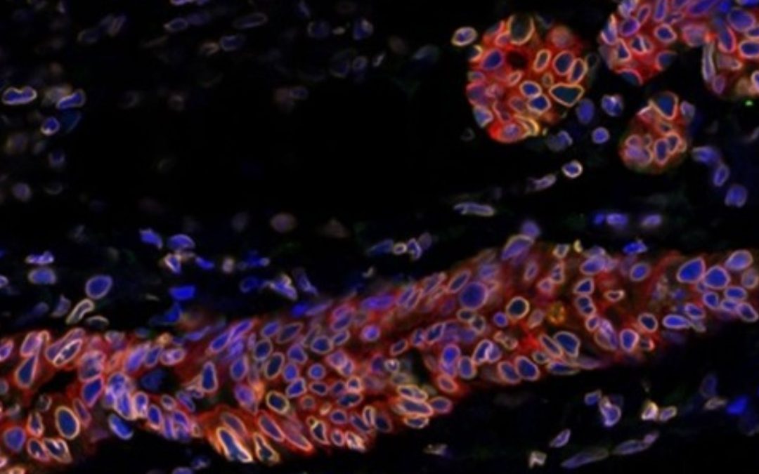 Rechutes du cancer du sein : découverte d’un mécanisme de résistance cellulaire clé